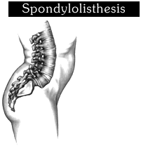 Spondylolisthesis3.gif