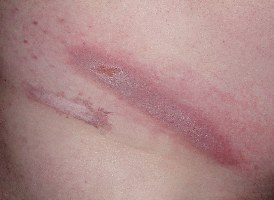 Druckstelle oberhalb der rechten Hüfte. Darunter ist ne Narbe zu sehen, die nichts mit dem Korsett zu tun hat.