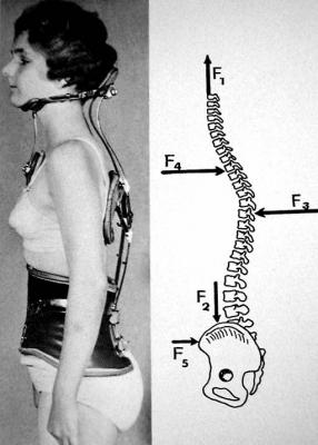 Das Milwaukee als hochwirksames Korsett gegen Kyphose ist "uralt". 
<br />Die Korrektur-Prinzipien sind klar und logisch.