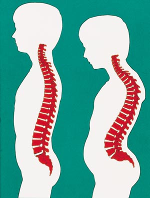 "Gesunde" Haltung und sagittale (seitliche) Fehlstatik der Wirbelsäule beim Kind