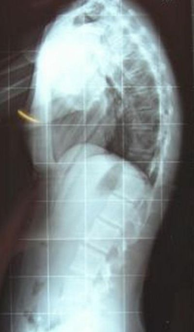 Morbus Scheuermann 60°