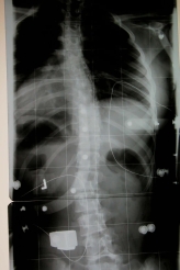 15 ° im Korsett (Primärkorrektur nach 14 Tagen)