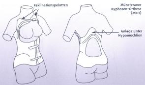 So sollte eine MKO konstruiert sein