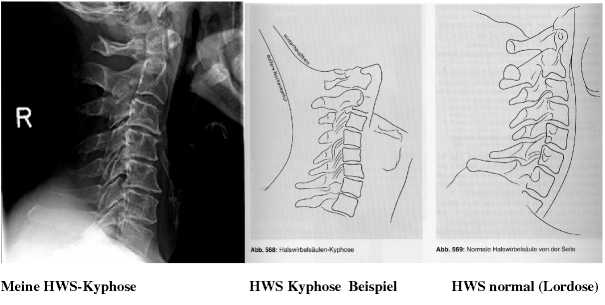 Grafiken aus dem Buch von Christa Lehnert-Schroth, Seite 237
<br />HWS Kyphose mit Scheitel bei C3/4