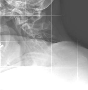 Bild der HWS, leider etwas undeutlich