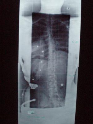th. 19° lu. 15° mit Korsett und mit Erhöhung 1.5 cm
