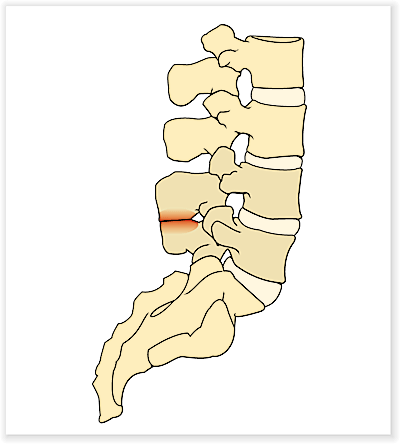 Das ist der Morbus Baastrup-Dornfortsatz-Konflikt.