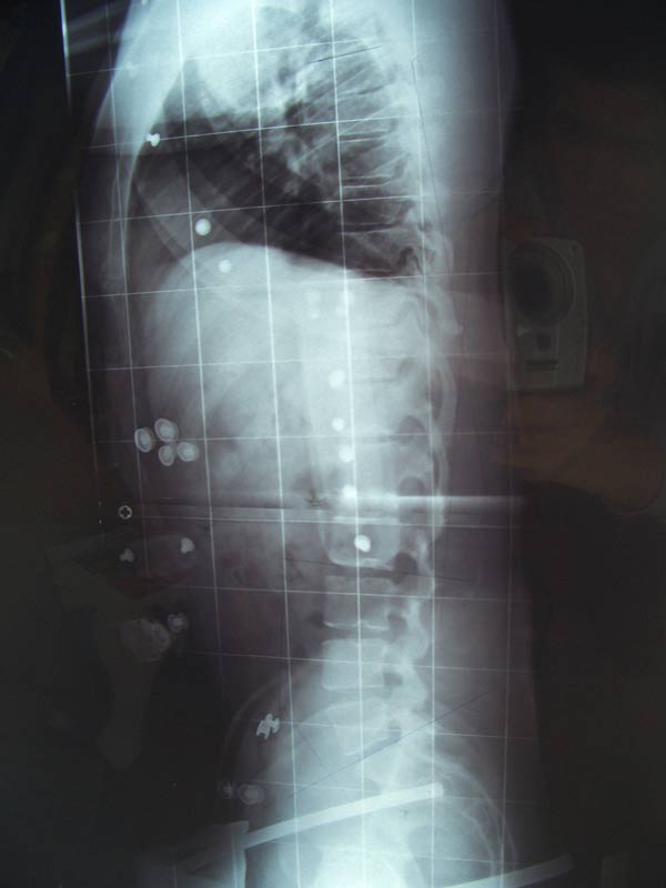 Hyperlordose korrigiert von 78° auf 39°
<br />Kyphose von 19° auf 14°
<br />Nicht mehr aus dem Lot