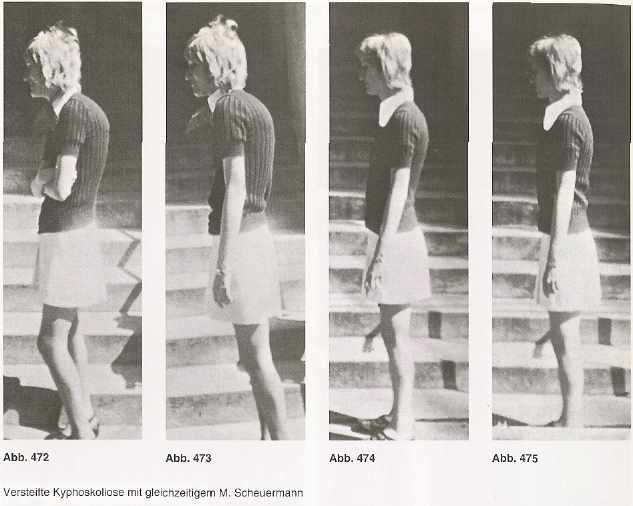 Ergebnis nach einer mehrmonatigen konsequenten Schroth-Reha