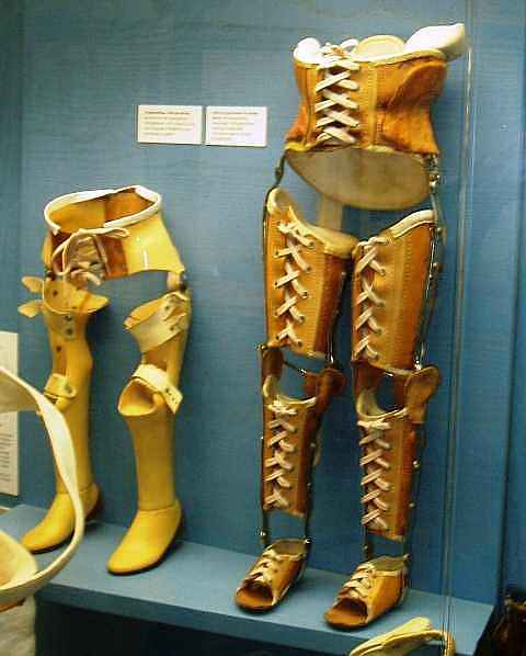 Bein-Apparate für Kinder bei Beinlähmungen z.B. bei Polio und bei Bein-Mißbildungen z.B. in Folge der Contargan-Erkrankung