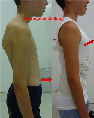 flexible hk, korsett ohne bügel