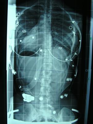 Heute im Korsett:
<br />Thorakal: 5°
<br />Lumbal: 4°