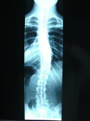 November 09 in der Uniklinik Köln ohne Korsett:
<br />Thorakal: 28°
<br />Lumbal: 21°
<br />
<br />
<br />(Irre ich mich oder ist das Bild so schlecht dass man noch nicht mal die Wirbel erkennen kann? Tztz =P )