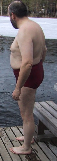 Meine totale Schmerz-Scheuermann-Kyphose vor Therapiebeginn