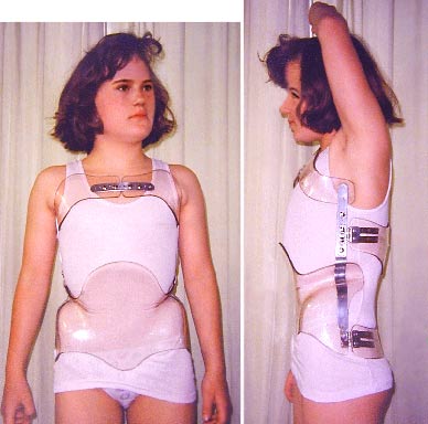 Das ist das dauertragbare Tübinger-Kyphosen-Korsett. Die Erfolge gegen Keilwirbel sollen sehr gut sein.