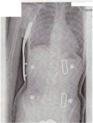das war das ergebinis vom röntgen im korsett
