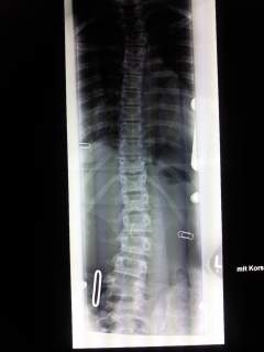 Bild vom 12.10.2010 im Korsett<br />10° th. 19° lumb.