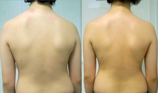 Das ist die Ansicht von dorsal vor (links) und nach (rechts) Therapie.