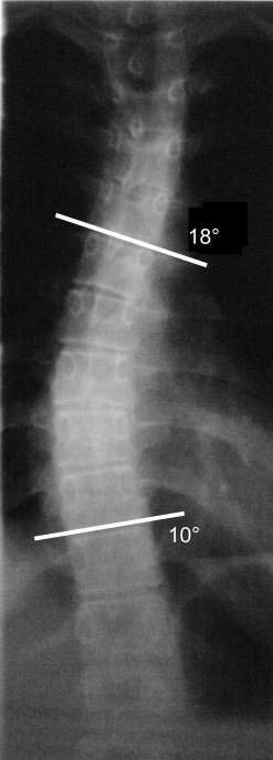 Röntgenbild mit Winkelmessung