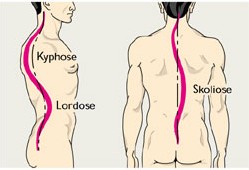 Zur Erklärung: Skoliose/Kyphose/Lordose