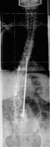 Harrington, 2 Stäbe.jpg