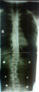 nach 3 Monaten im Korsett
