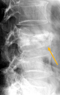 Beispiel eines "konsolidierten" WK-Einbruchs