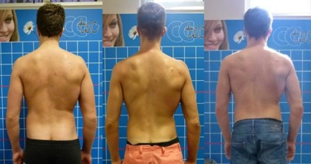 Mein Rücken im November 2011, August 2013 und März 2014