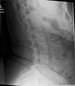 Bild LSPINE seitlich (untere Wirbelsäule)<br /><br />L bedeutet lower Spine?