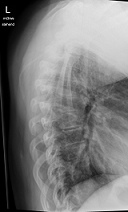 TSPINE seitlich (oberer Abschnitt)<br /><br />T bedeutet Top Spine?