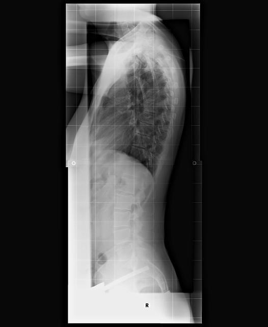 Röntgenbild vor der CCtec-Korsett-Therapie 11.2014
