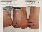 Beinlängendifferenz Tochter