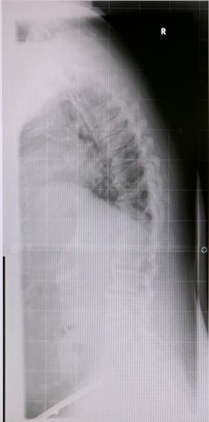 Röntgenbild nach zwei Wochen ohne Korsett