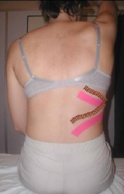 Tapen gegen Skoliose?