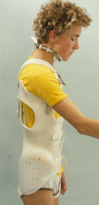 Eine Thorako-cervicale Skoliose ist konservativ nicht unerreichbar, wenn der Patient bereit ist eine Kopfstütze zu (er)tragen!