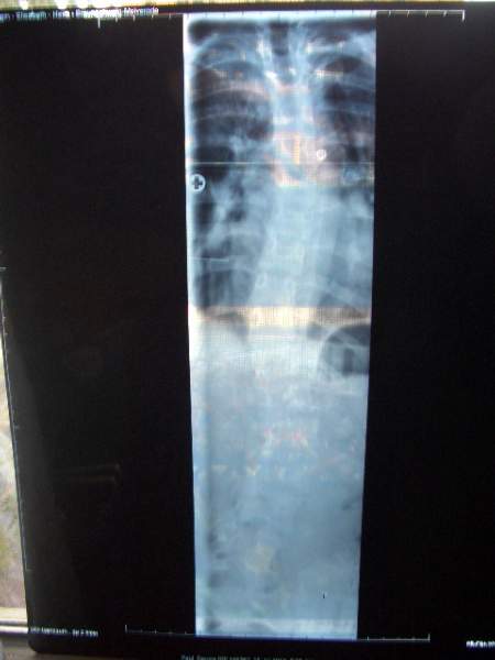 Skoliose3.jpg