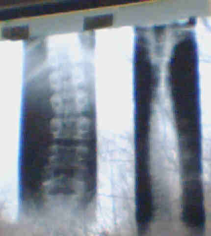 LWS und BWS von hinten