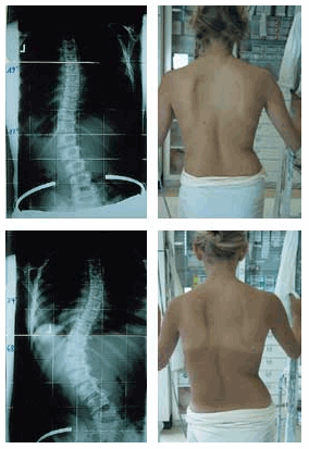 Beispiel für die Progredienz
<br />Innerhalb von 7 Monaten verschlechterte sich die Skoliose der 13-jährigen Patientin von 19° thorakal, 27° lumbal auf  34° thorakal, 68° lumbal