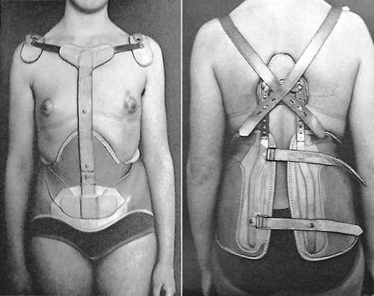 Anti-Kyphose-Korsett auf Milwaukee-Basis aber ohne Halsring