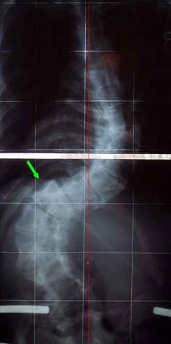 Skoliose mit 93° und 98°
