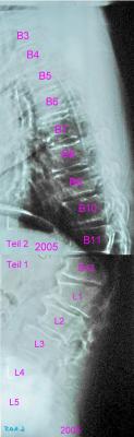 elektronisch zusammengesetzte Aufnahme mit Flachrücken oben, Sitzkyphose (tiefe Hyperkyphose) mit Scheitel bei BWS 11/12 und darunterliegendem Hohlkreuz (kurze Hyperlordose).