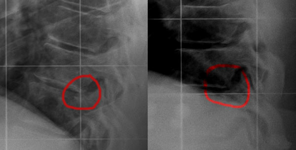 Ich habe in diesem Bereich der Brsutwirbelsäule hin und wieder recht starke Schmerzen. Berühren sich da die Wirbelkörper? Es handelt sich um die Wirbel TH 9 und 10