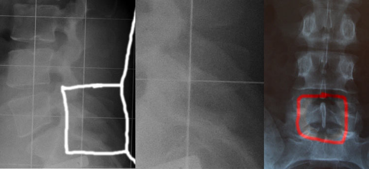 Auf dem Röntgenbild von vorne (Bild rechts) ist der Dornfortsatz von L5 zu lang. AUf dem Bild im Korsett kann man ihn sehen und er sieht meiner Meinung nach nicht so lang aus wie auf dem Bild von vorne. Aber was ist das eingekreiste und vergrößerte? Hat s