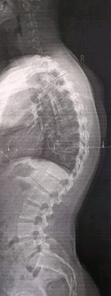 70° Hyperkyphose 2018-min.jpg